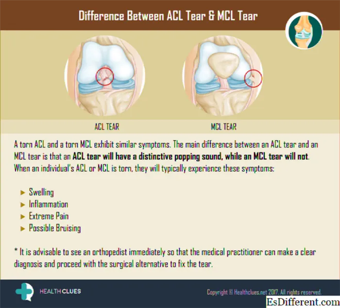 Разница между ACL и идеей